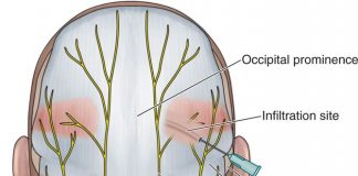 Blocco del nervo occipitale