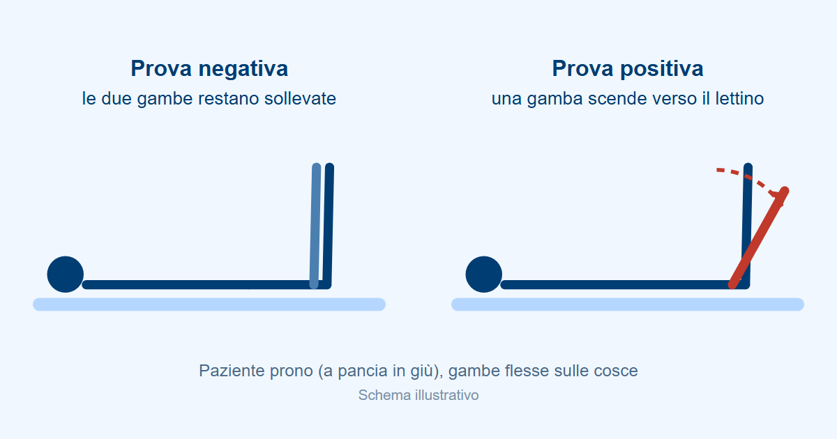Schema della manovra di Barré: paziente prono con le gambe flesse sulle cosce; nella prova positiva una gamba scende verso il lettino
