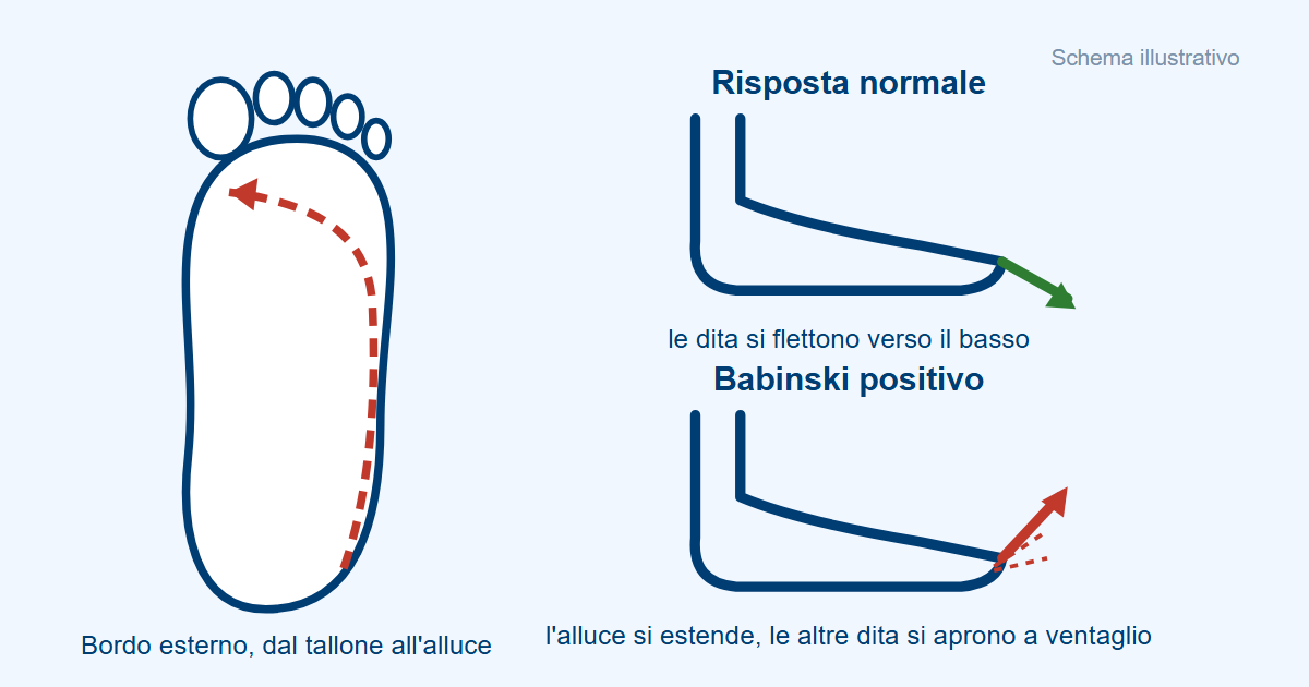 Schema del segno di Babinski: stimolo lungo il bordo esterno della pianta del piede; risposta normale in flessione e Babinski positivo con estensione dell'alluce e dita a ventaglio